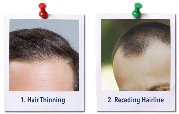 hair-loss-signs