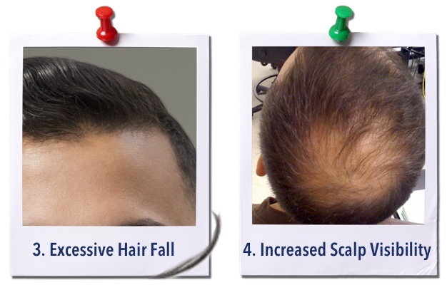 hair-loss-signs